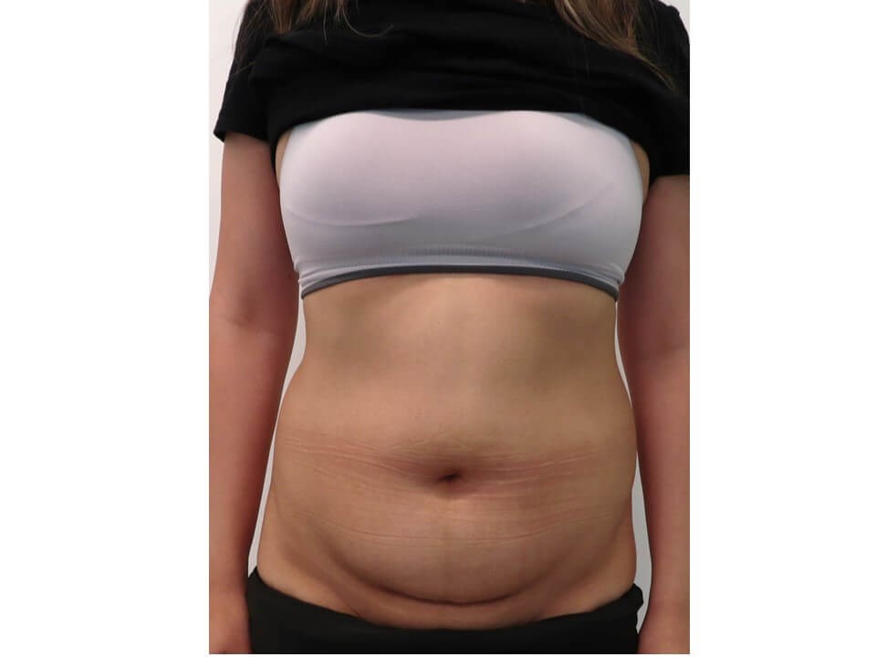 Liposuction Before