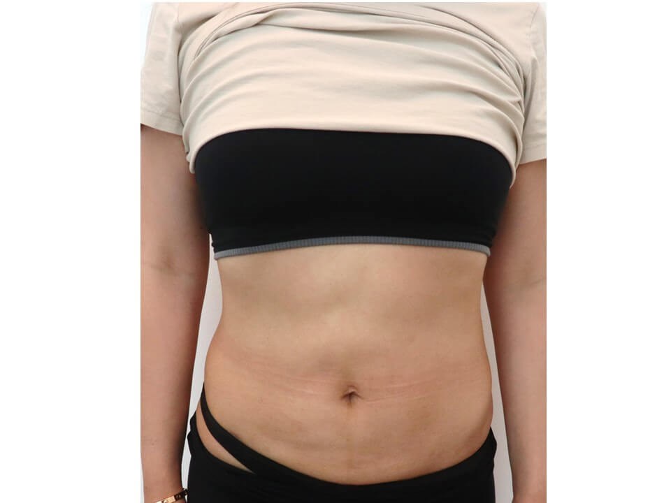 Liposuction After