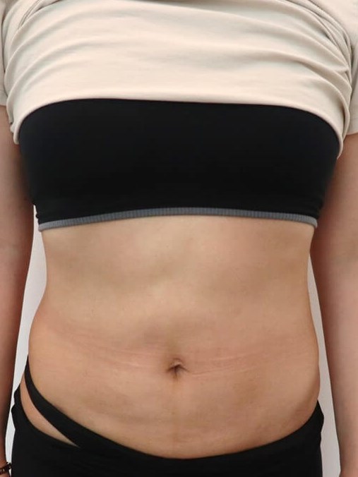 Liposuction After