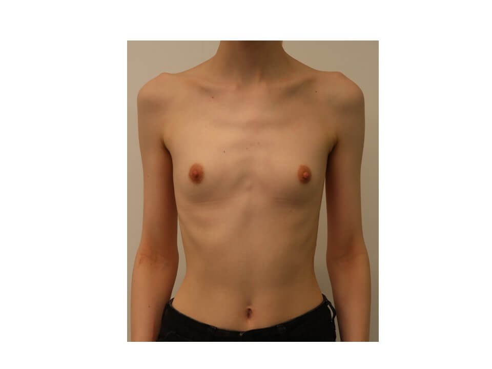 Breast Augmentation Before
