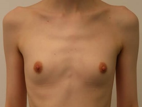 Breast Augmentation Before