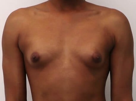 Breast Augmentation - M to F Before