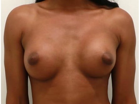Breast Augmentation - M to F After