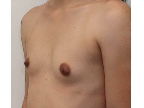 Breast Augmentation Before