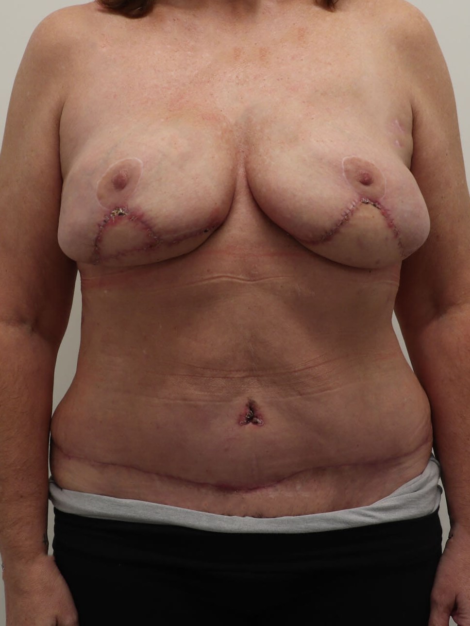 Breast Reconstruction After