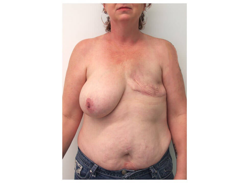 Breast Reconstruction Before