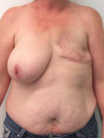 Breast Reconstruction Before