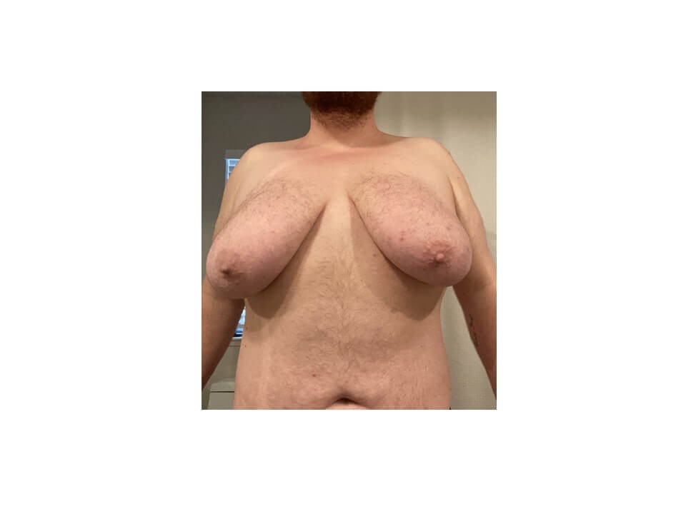 Mastectomy - Female to Male Before