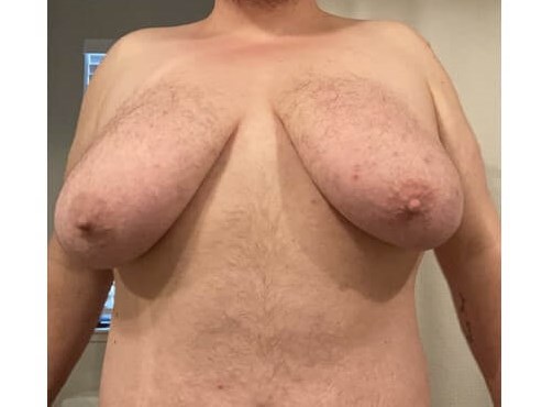 Mastectomy - Female to Male Before