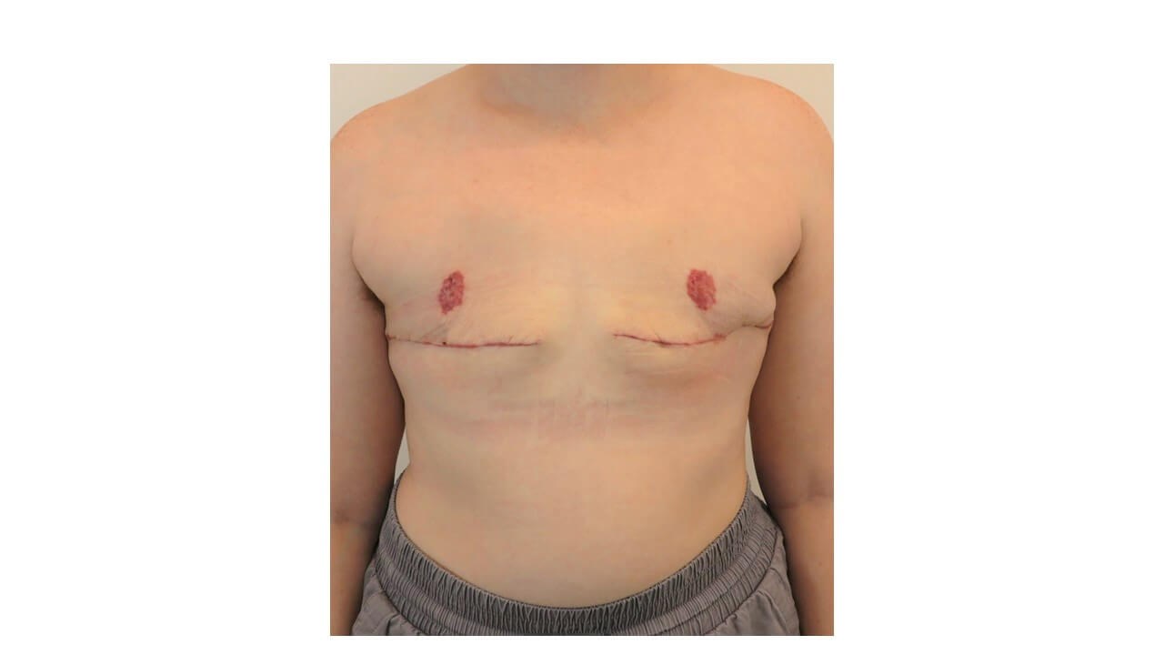 Mastectomy- Female to Male After