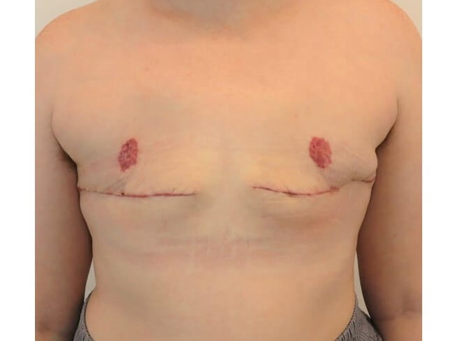 Mastectomy- Female to Male After