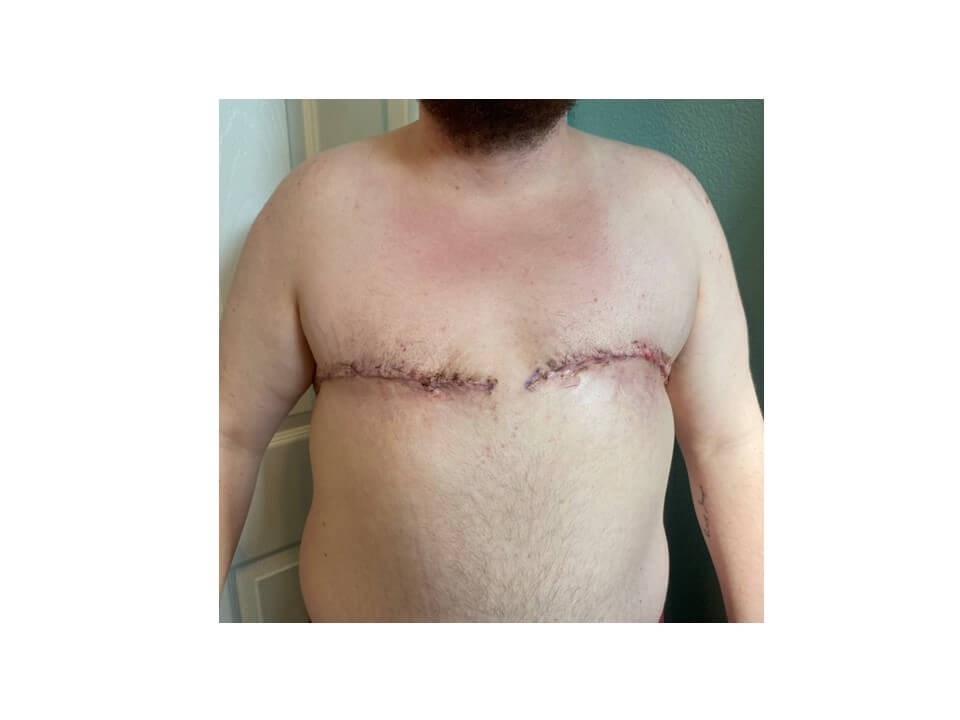 Mastectomy - Female to Male After