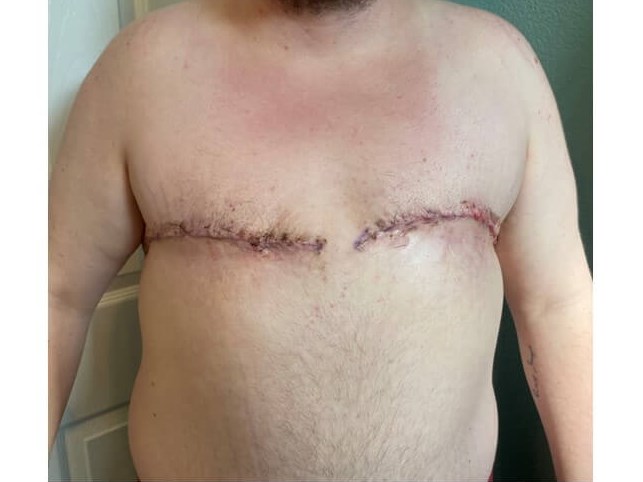 Mastectomy - Female to Male After
