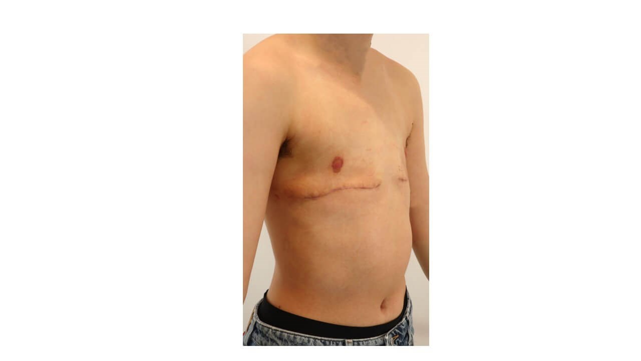 Mastectomy- Female to Male After