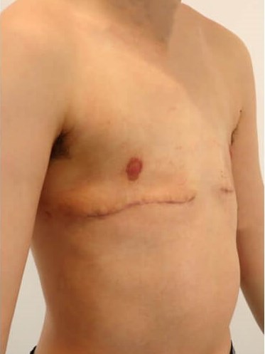 Mastectomy- Female to Male After