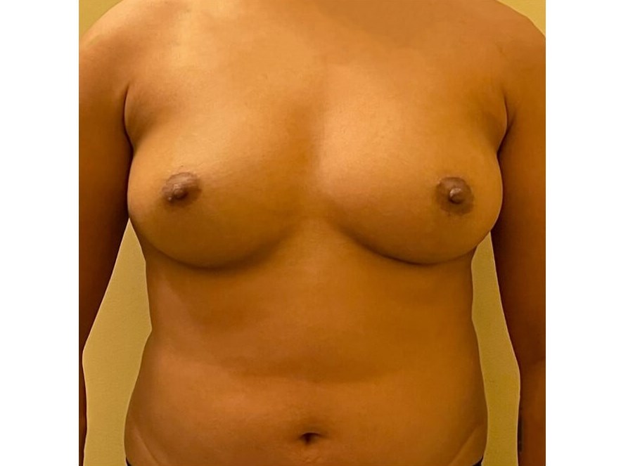 Mastectomy - Female to Male Before