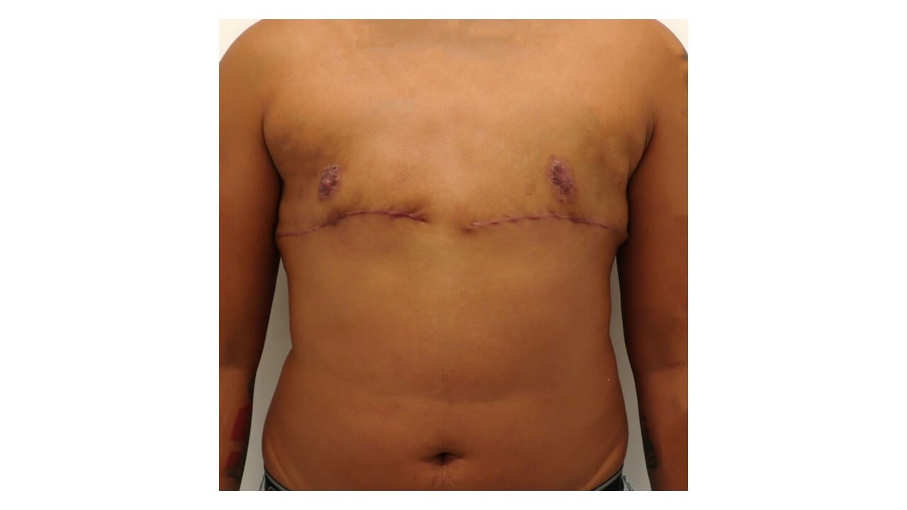 Mastectomy - Female to Male After