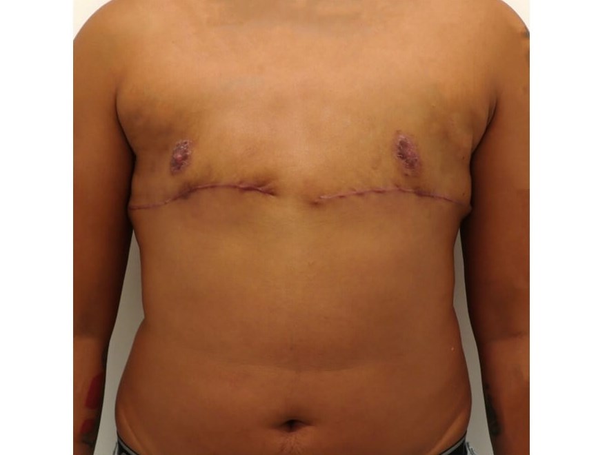 Mastectomy - Female to Male After