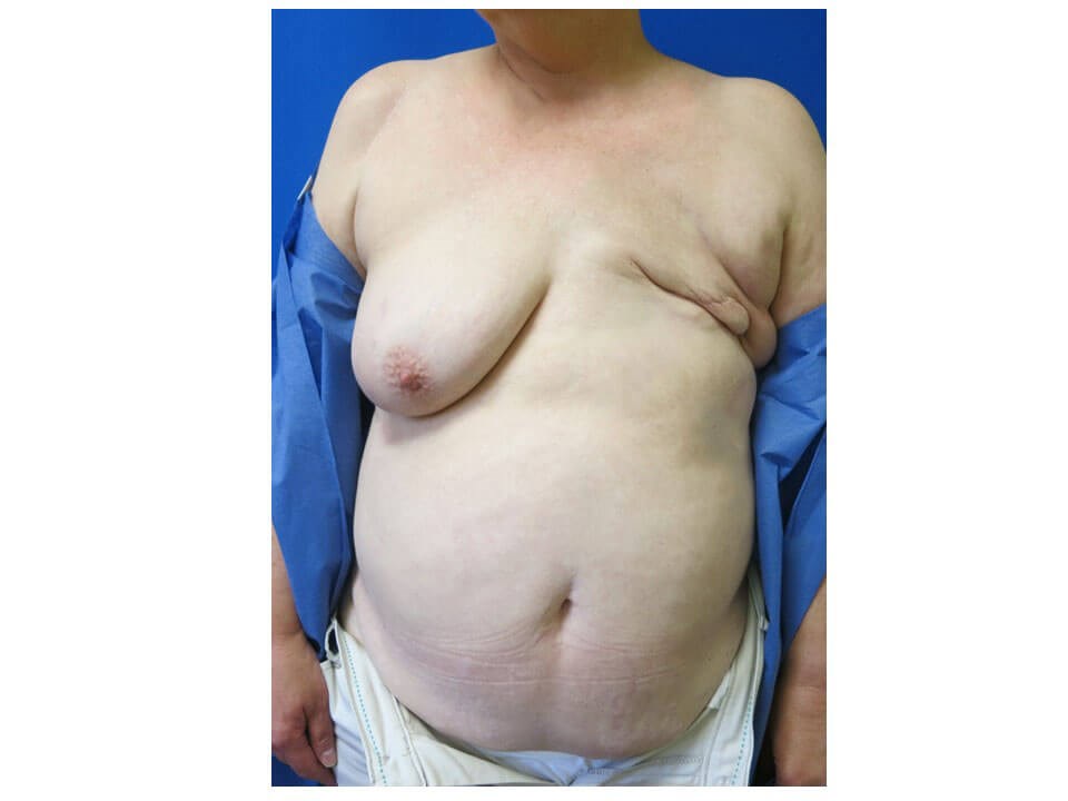 Breast Reconstruction Before