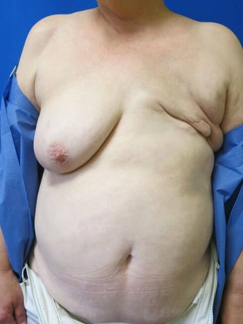 Breast Reconstruction Before