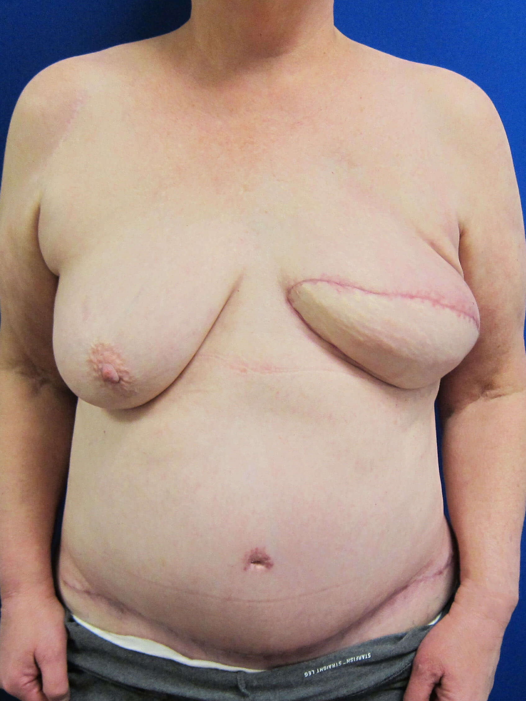 Breast Reconstruction After
