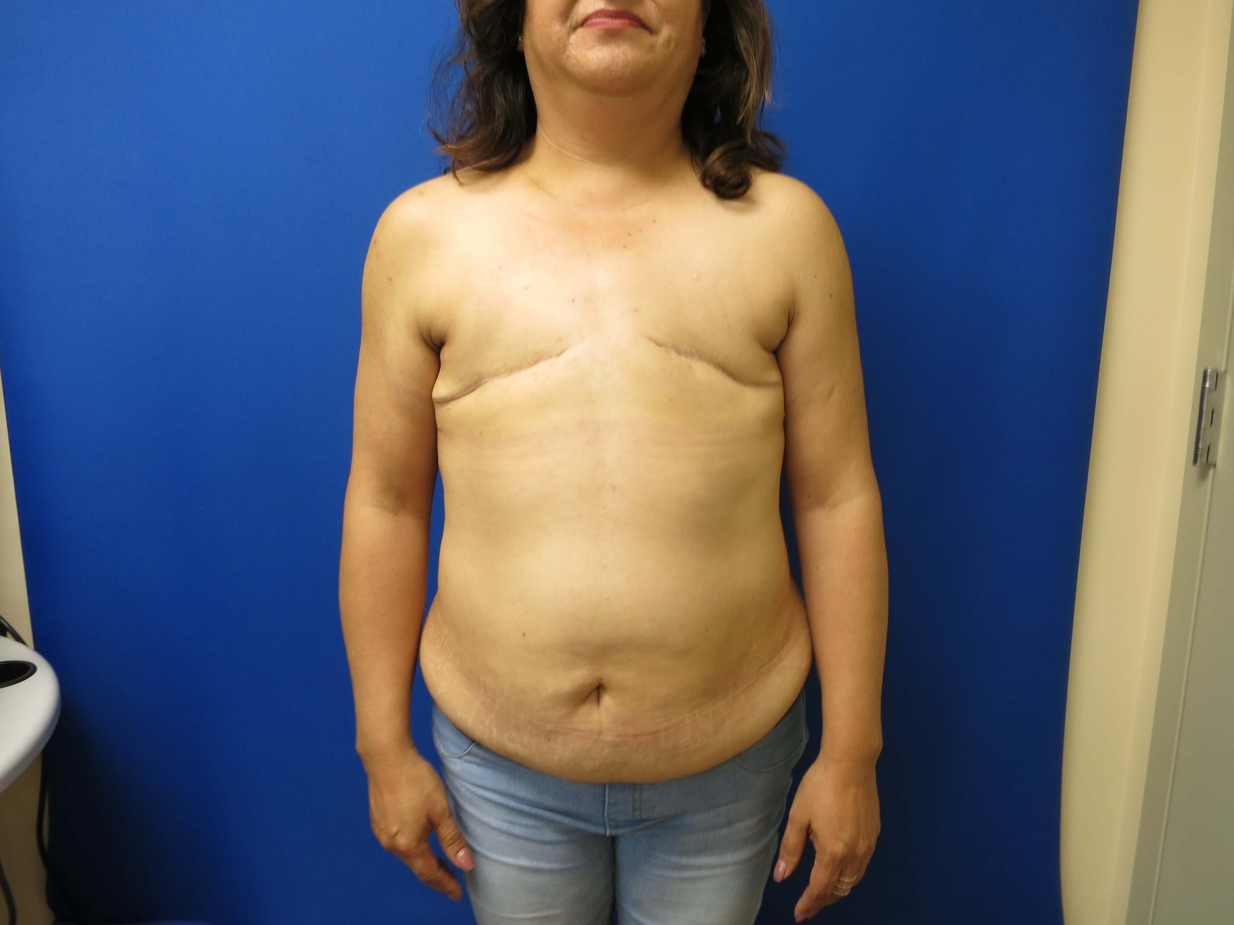 Breast Reconstruction Before