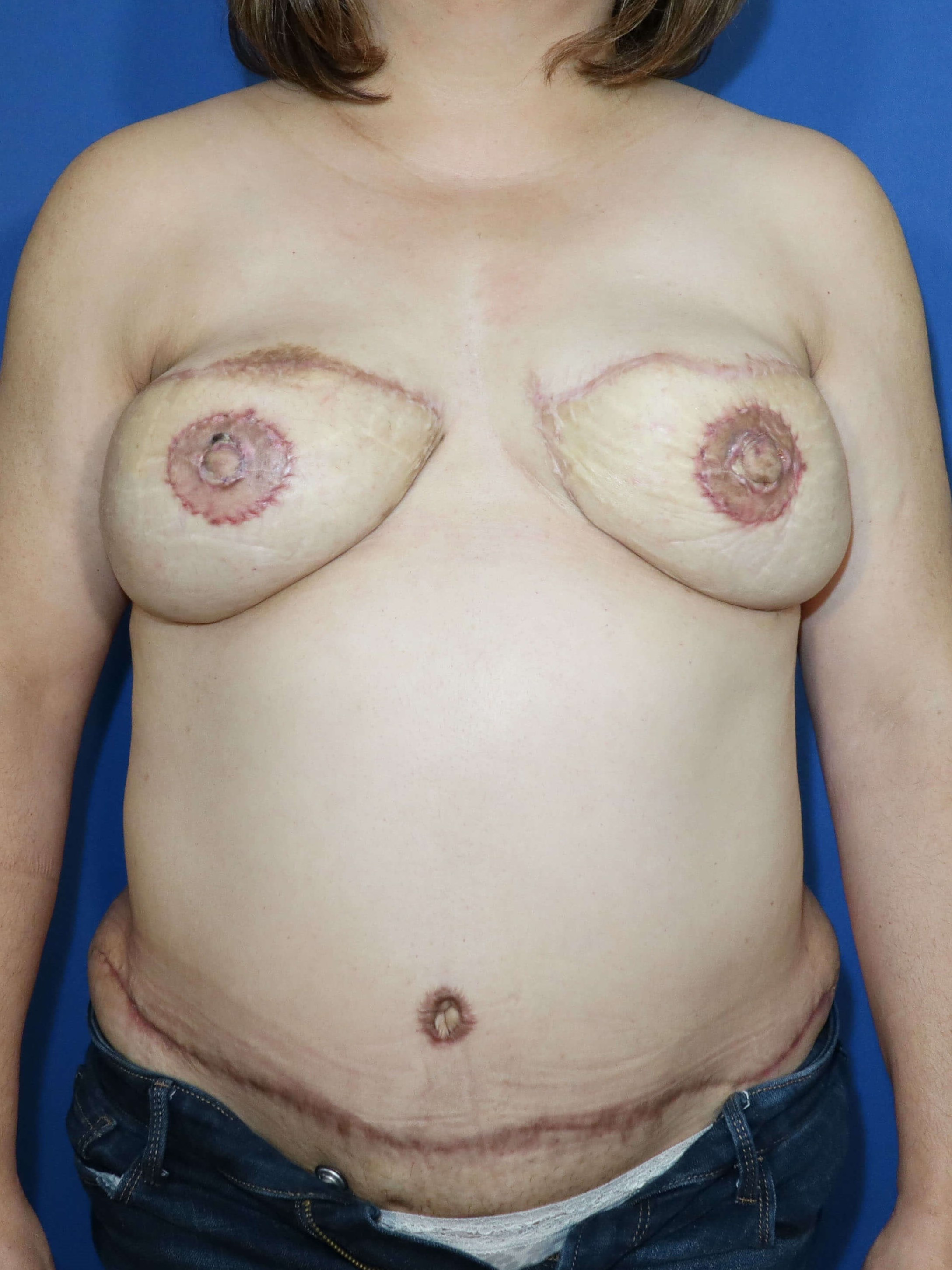 Breast Reconstruction After