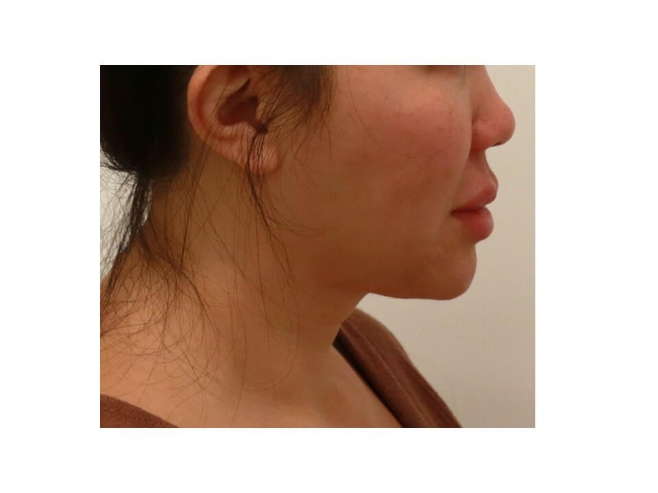 Liposuction Before