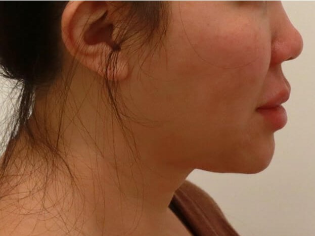 Liposuction Before