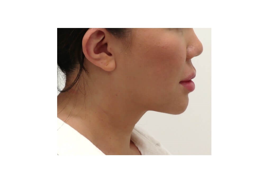 Liposuction After