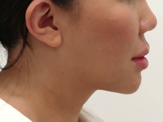 Liposuction After