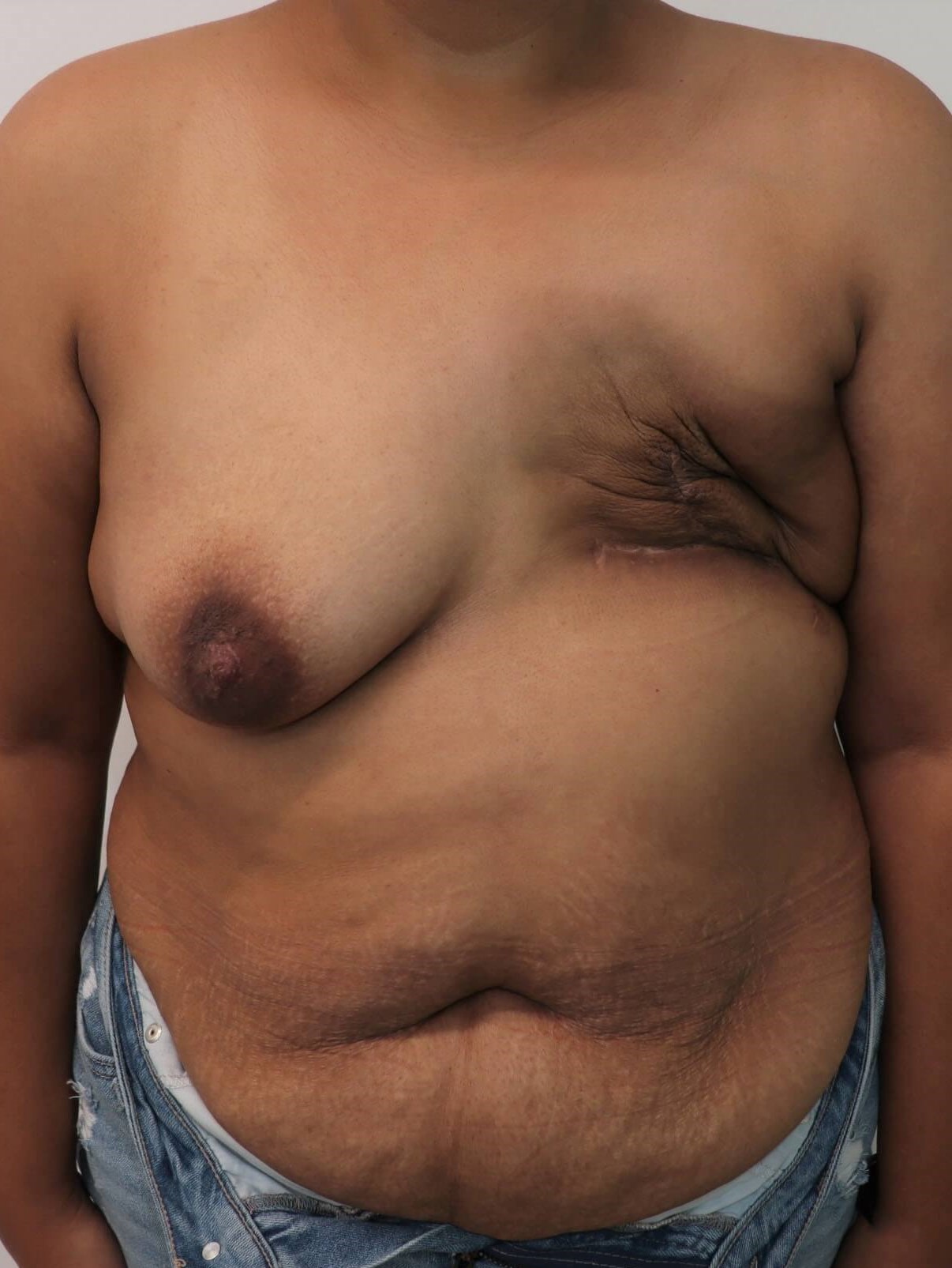 Breast Reconstruction Before