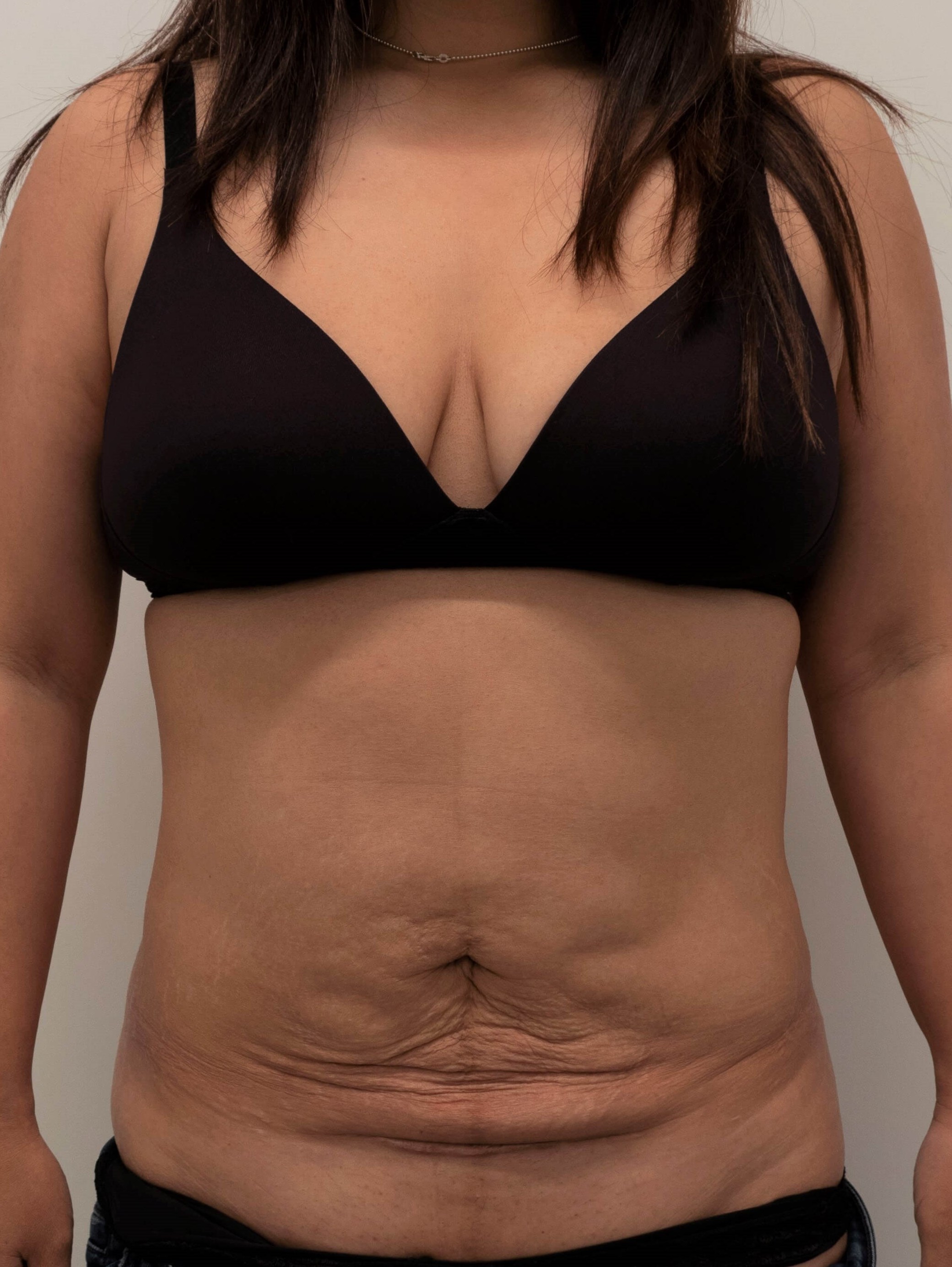 Abdominal Liposuction Before