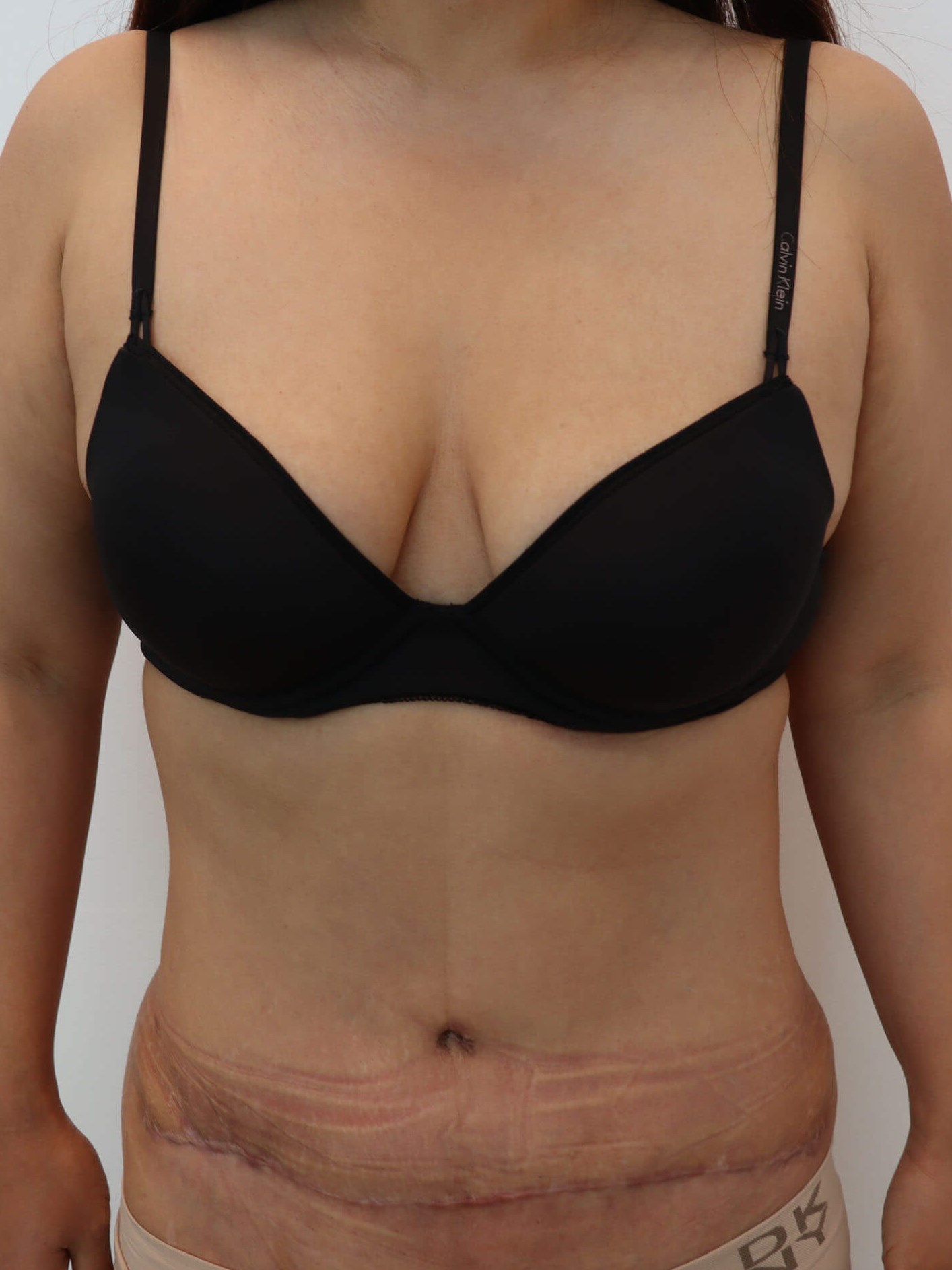 Abdominal Liposuction After