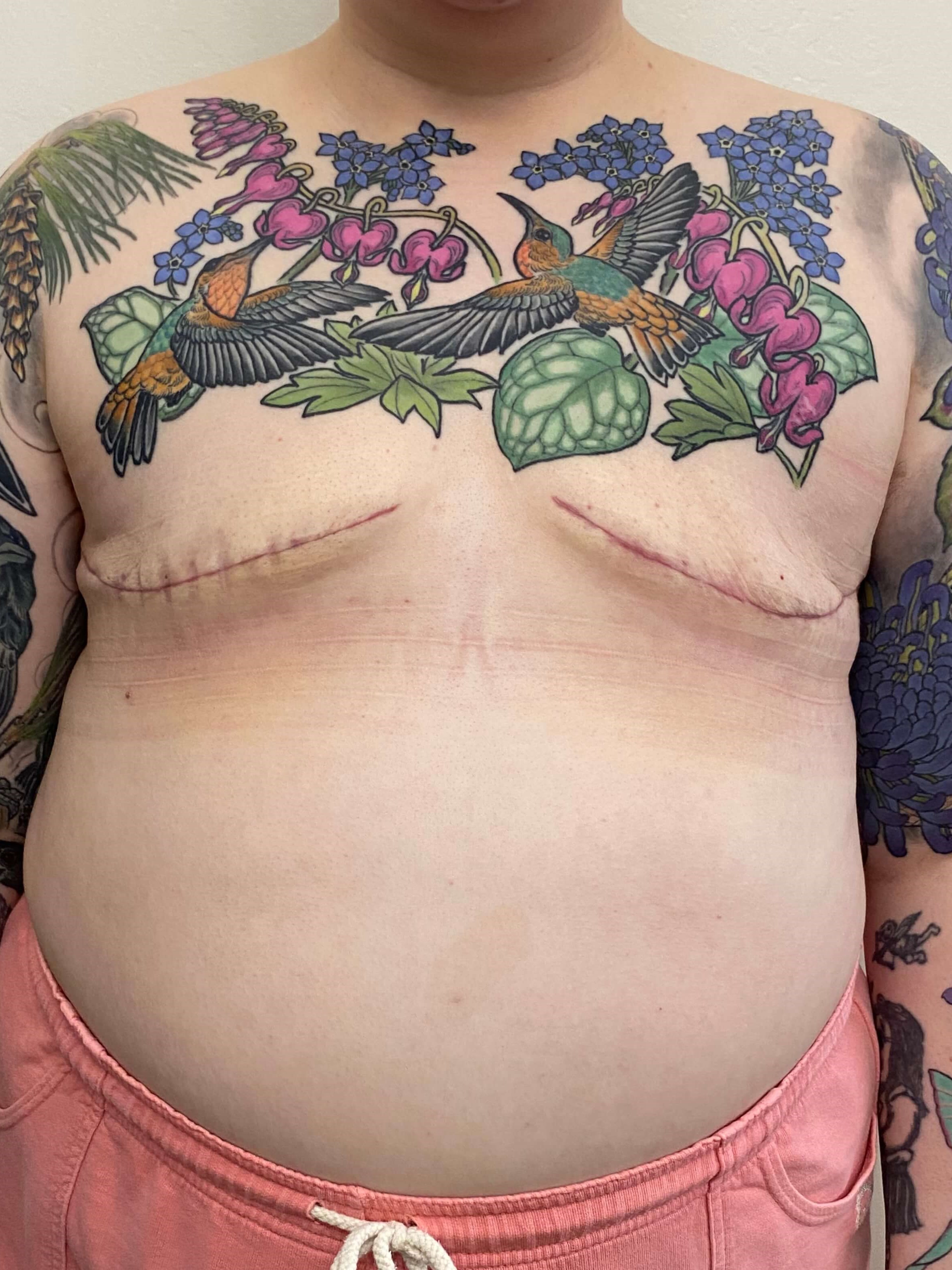 Mastectomy - Female to Male After