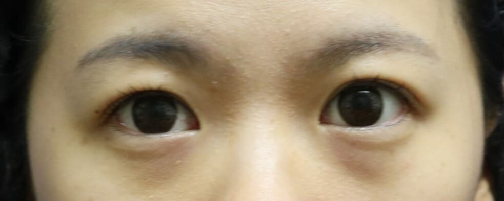 Asian Eyelid Surgery Before