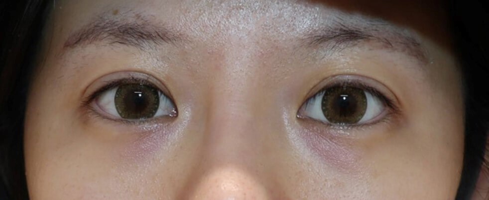 Asian Eyelid Surgery After
