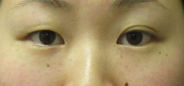 Asian Eyelid Surgery Before