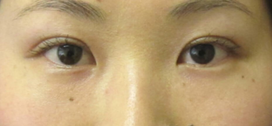 Asian Eyelid Surgery After