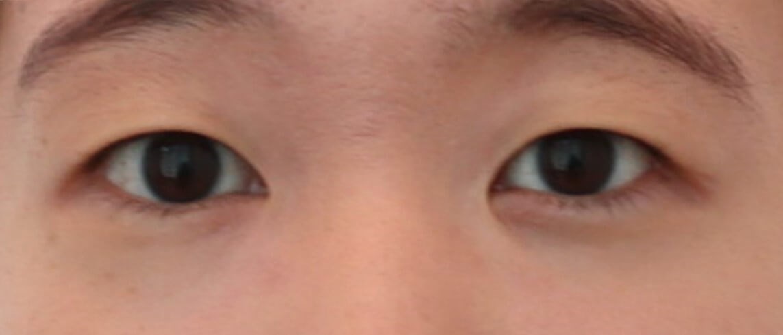 Asian Eyelid Surgery Before