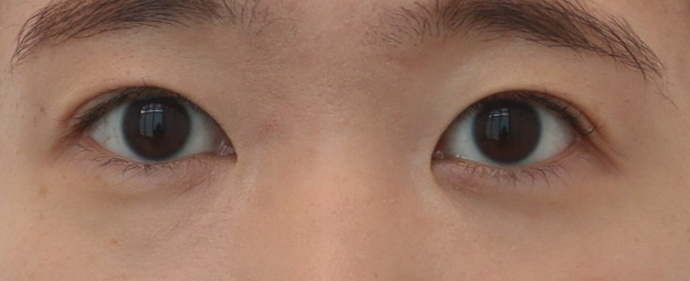 Asian Eyelid Surgery After