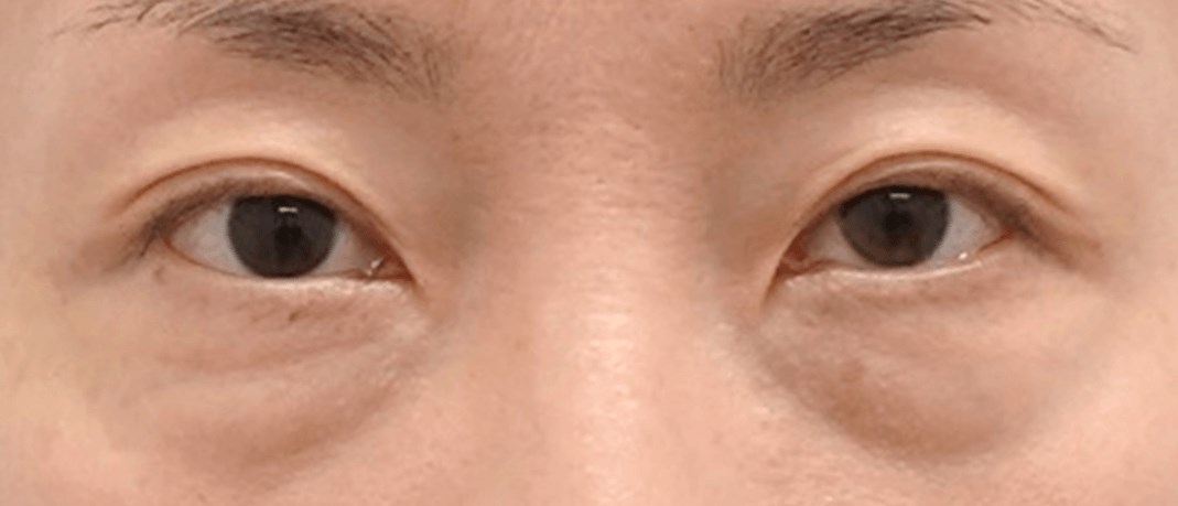 Lower Eyelid Surgery Before