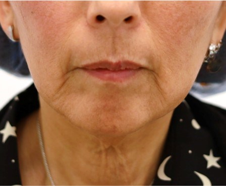 Facelift Surgery Before