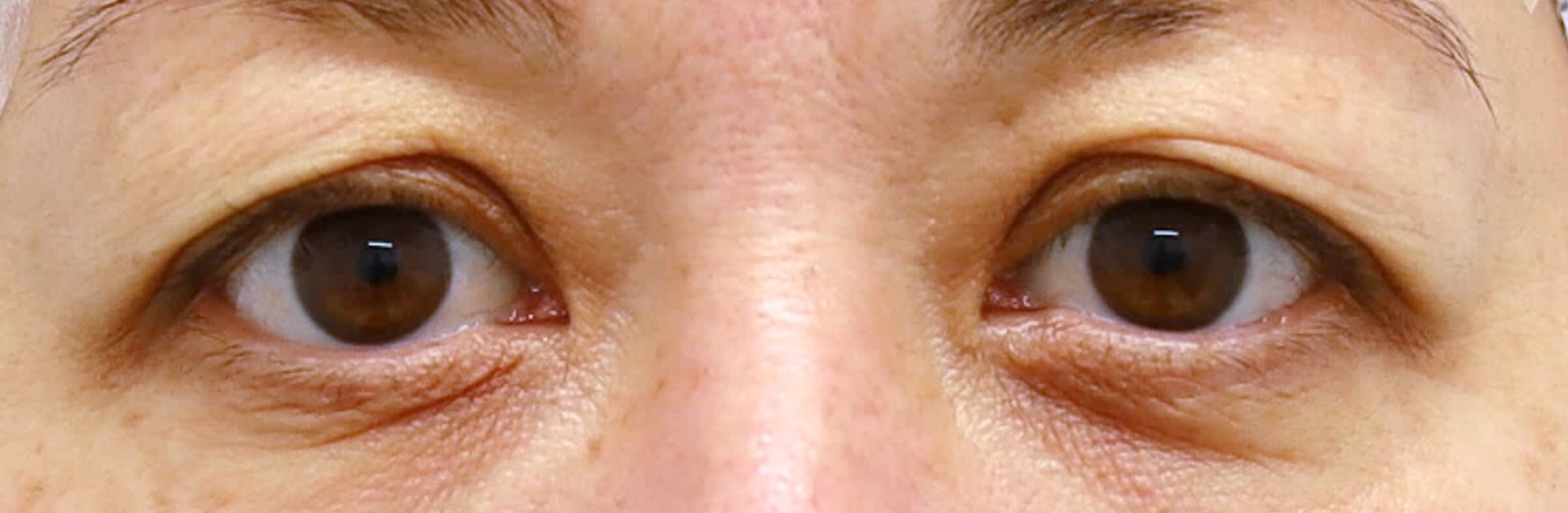 Upper Eyelid Surgery Before
