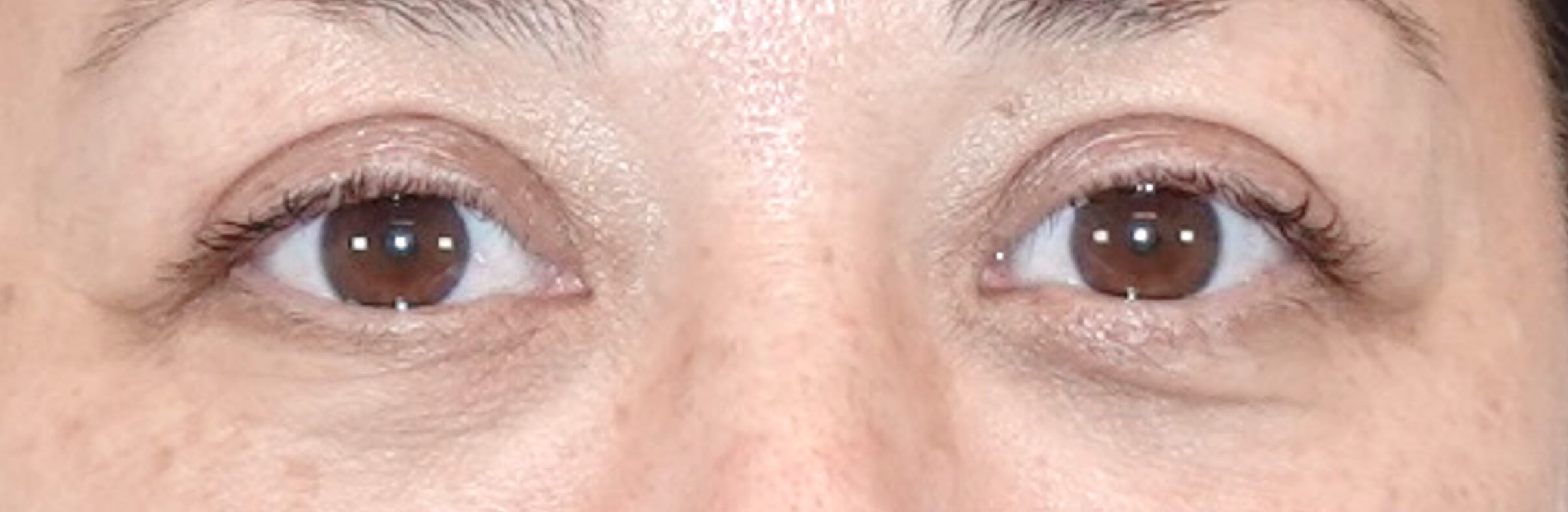 Upper Eyelid Surgery After