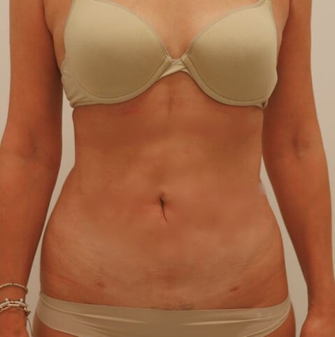 Abdominal Liposuction After