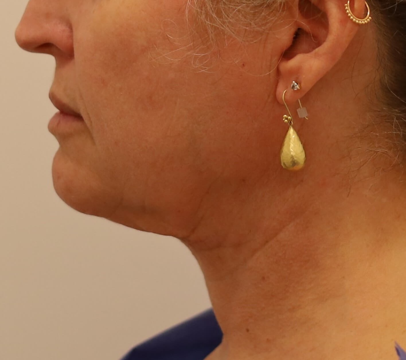 Neck Liposuction Surgery After