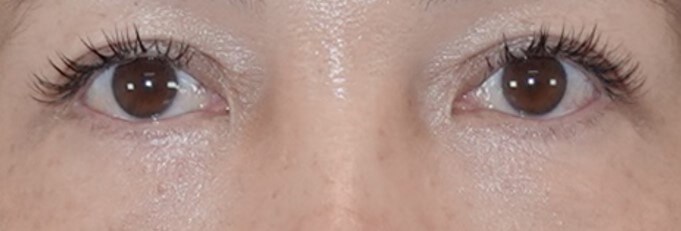 Upper & Lower Eyelid Surgery After