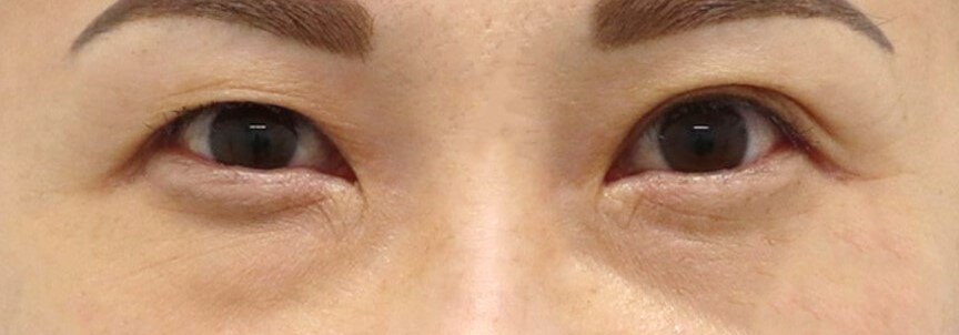 Upper Eyelid Surgery Before