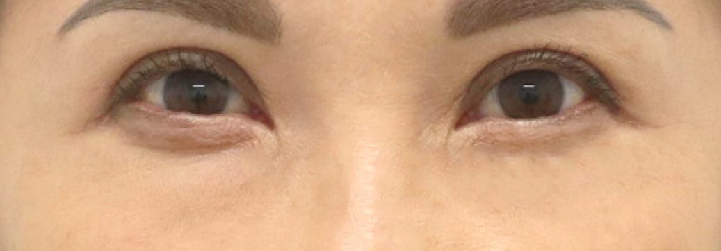 Upper Eyelid Surgery After